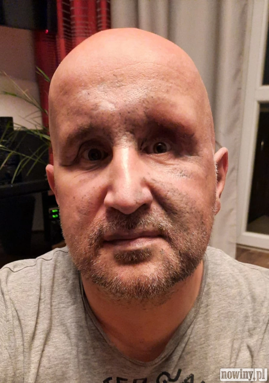 Saper z Gliwic cudem uniknął śmierci w Kuźni Raciborskiej. Teraz walczy o powrót do normalnego życia