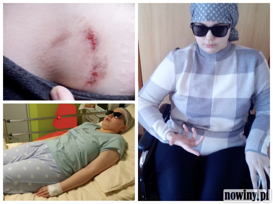 Samotna matka apeluje o zbiórkę na leczenie chorej córki. „Przez choroby Natalia staje się nikim”